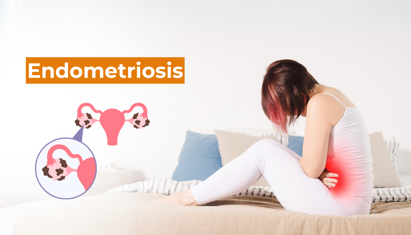 Endometriosis